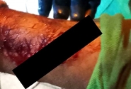 Trabalhador do caminho de lixo corta o brao com vidro descartado de forma incorreta em Gaspar