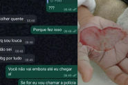 Madrasta é presa após queimar mão de enteada de propósito em Itajaí