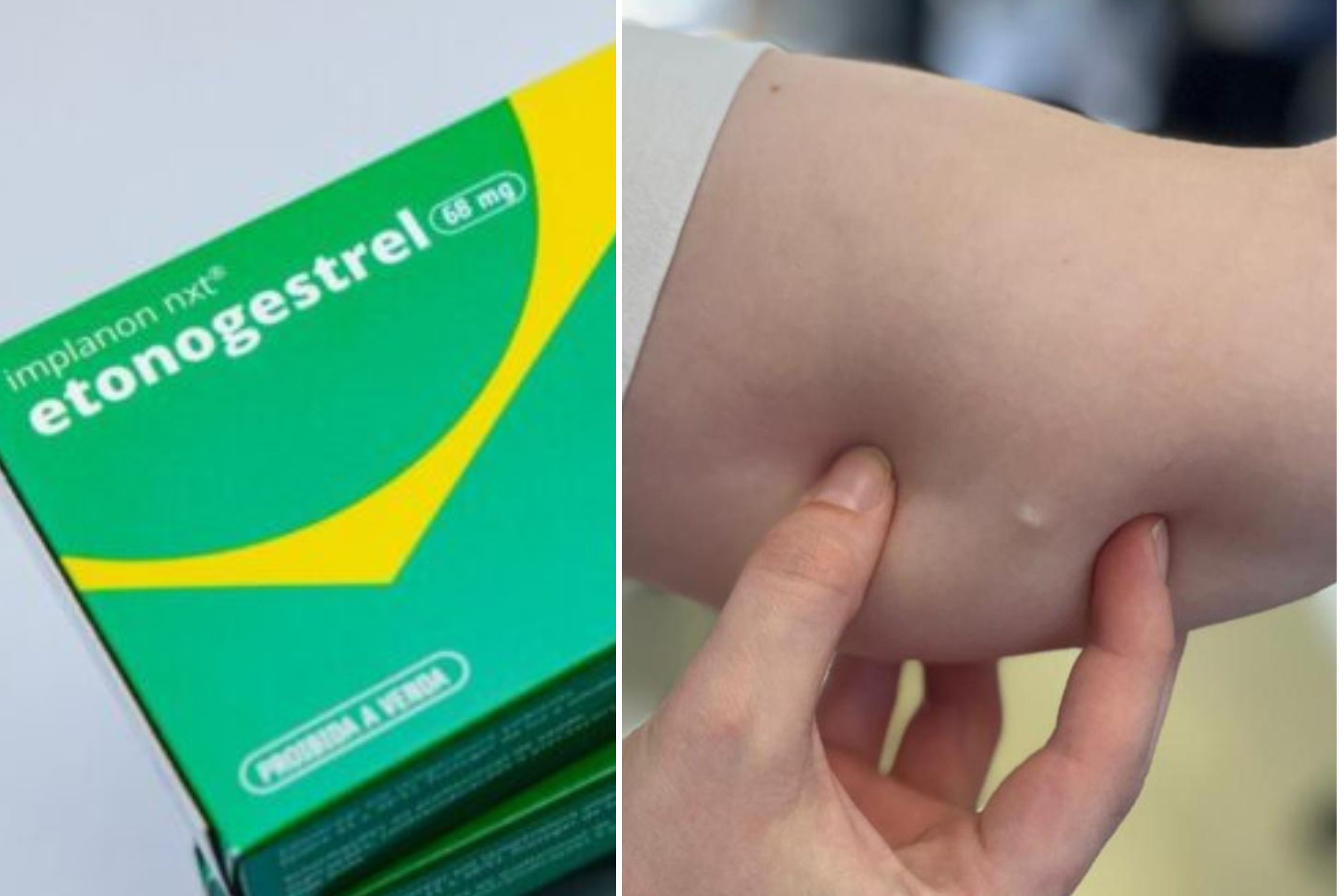 Gaspar disponibiliza implante contraceptivo Implanon de forma gratuita